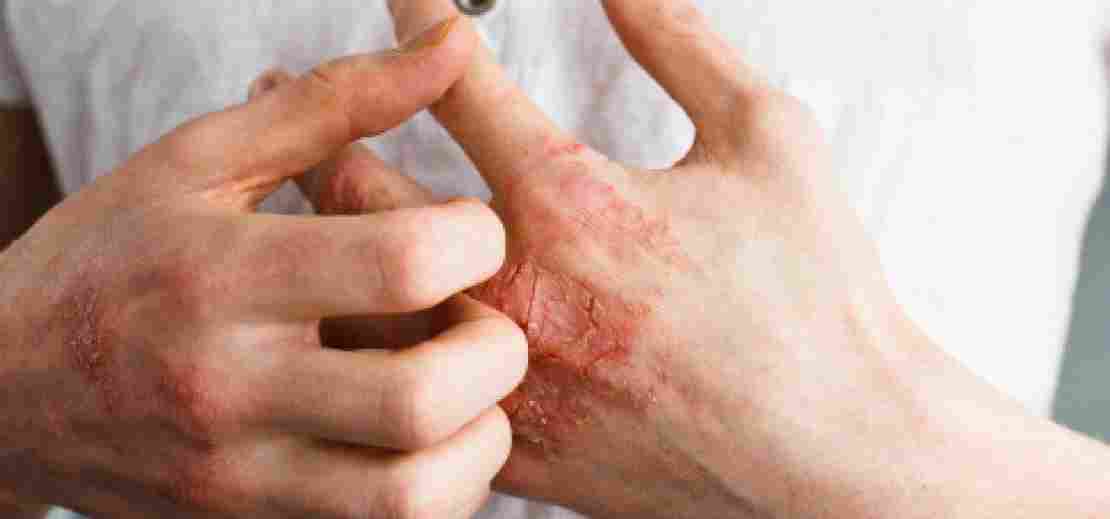 More Than Skin Deep—psoriasis And Mental Health — Which Doctor